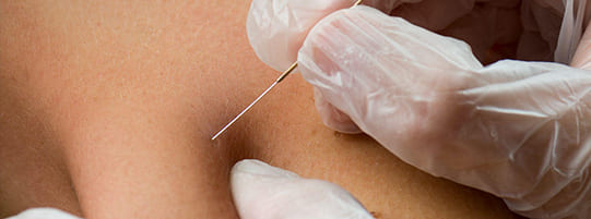 What is Dry Needling Physical Therapy? post