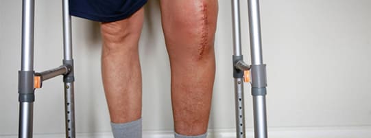 Why You Need Physical Therapy After a Joint Replacement post