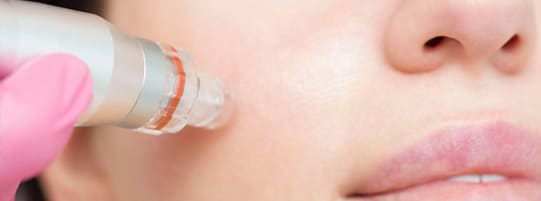 Is Microneedling or Botox Better for Wrinkles? post