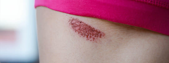 How To Tell If You Have Soft Tissue Damage After a Car Accident post