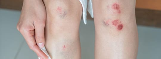 How Do I Know If I Have Soft Tissue Damage? post