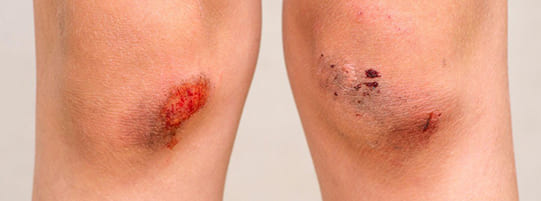 What Are the Most Common Leg Injuries From an Auto Accident? post
