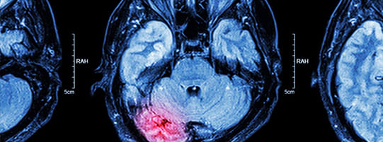 What Are the Different Types and Levels of Brain Injuries? post