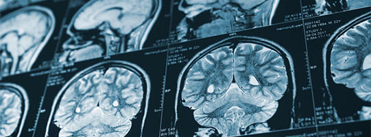 Does Whiplash Show Up on a CT Scan? post