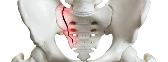 How Do You Know If You Have a Fractured Sacrum? Warning Signs & Treatments post