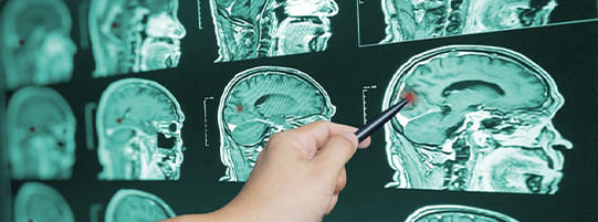 How Is the Severity of a Traumatic Brain Injury Determined? post