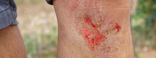 Most Common External & Internal Injuries From Motorcycle Accidents post