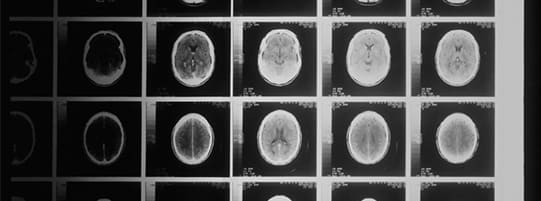 What Techniques Are Used in Diagnosing Traumatic Brain Injuries? post