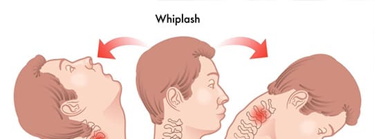 What Are the Different Stages of Whiplash and How Are They Treated? post
