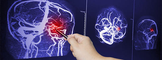 What Are the Top Causes of Traumatic Brain Injuries (TBI)? post