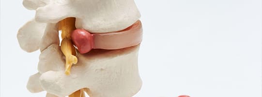 Have A Herniated Disc From An Accident? Consider A Percutaneous Discectomy post