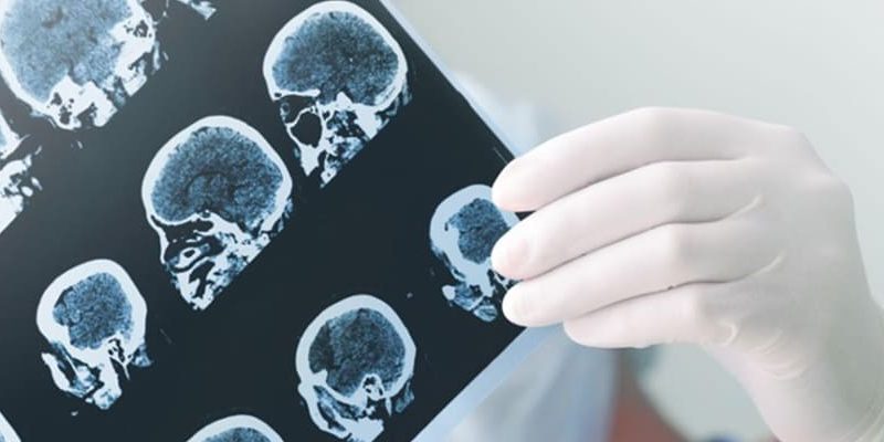 Can TBIs Worsen Years After the Original Head Trauma? post