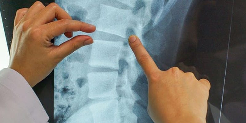 Cervical, Thoracic, & Lumbar Discography FAQ post