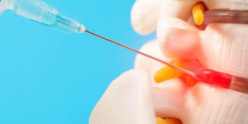 How Long Do I Need To Rest After A Nerve Root Block Injection? post